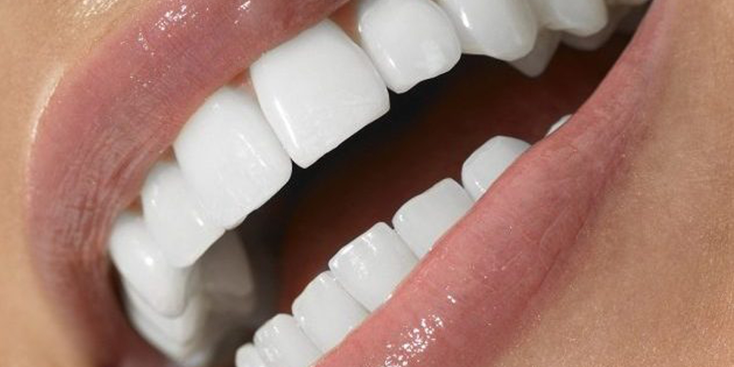 Що таке вініри для зубів і які краще?